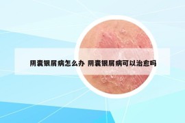 陰囊銀屑病怎么辦 陰囊銀屑病可以治愈嗎