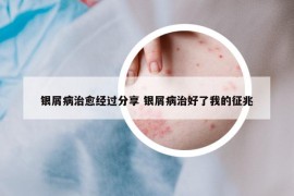 銀屑病治愈經(jīng)過分享 銀屑病治好了我的征兆