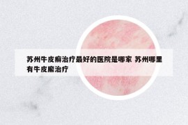 蘇州牛皮癬治療最好的醫(yī)院是哪家 蘇州哪里有牛皮廨治療