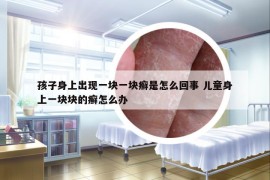孩子身上出現(xiàn)一塊一塊癬是怎么回事 兒童身上一塊塊的癬怎么辦