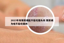 2023年有銀屑病能不能吃豬頭肉 銀屑病為啥不能吃豬肉