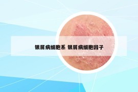銀屑病細(xì)胞系 銀屑病細(xì)胞因子