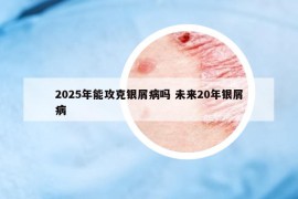 2025年能攻克銀屑病嗎 未來(lái)20年銀屑病