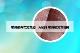 銀屑病再次復(fù)發(fā)是什么征兆 銀屑病復(fù)發(fā)誘因