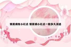 銀屑病有小紅點(diǎn) 銀屑病小紅點(diǎn)一般多久消退
