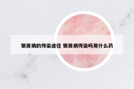 銀屑病的傳染途徑 銀屑病傳染嗎用什么藥