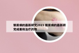 銀屑病的最新研究2023 銀屑病的最新研究成果和治療藥物