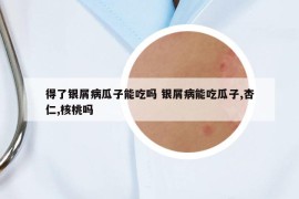 得了銀屑病瓜子能吃嗎 銀屑病能吃瓜子,杏仁,核桃嗎