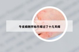 牛皮癬剛開(kāi)始不癢過(guò)了十幾天癢