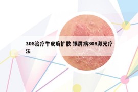308治療牛皮癬擴(kuò)散 銀屑病308激光療法