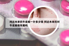 阿達(dá)木單抗牛皮癬一針多少錢 阿達(dá)木單抗對牛皮癬有效果嗎