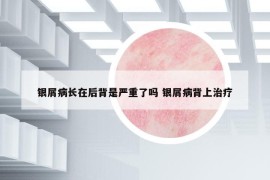 銀屑病長(zhǎng)在后背是嚴(yán)重了嗎 銀屑病背上治療