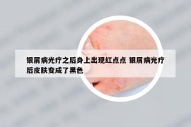 銀屑病光療之后身上出現(xiàn)紅點(diǎn)點(diǎn) 銀屑病光療后皮膚變成了黑色
