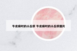 牛皮癬時(shí)的小丘疹 牛皮癬時(shí)的小丘疹圖片