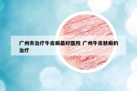 廣州市治療牛皮癬最好醫(yī)院 廣州牛皮膚癬的治療