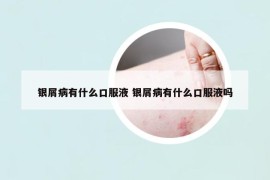 銀屑病有什么口服液 銀屑病有什么口服液嗎