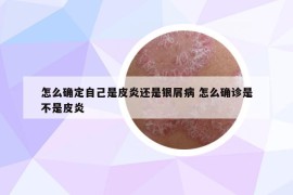 怎么確定自己是皮炎還是銀屑病 怎么確診是不是皮炎