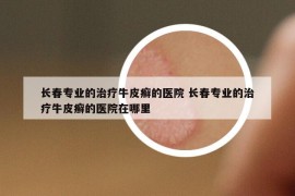 長春專業(yè)的治療牛皮癬的醫(yī)院 長春專業(yè)的治療牛皮癬的醫(yī)院在哪里