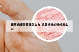 銀屑病癢得要死怎么辦 銀屑病癢的時候怎么辦
