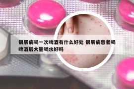 銀屑病喝一次啤酒有什么好處 銀屑病患者喝啤酒后大量喝水好嗎
