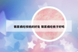 銀屑病吃核桃的好處 銀屑病吃桃子好嗎