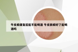 牛皮癬康復(fù)后能不能喝酒 牛皮膚癬好了能喝酒嗎