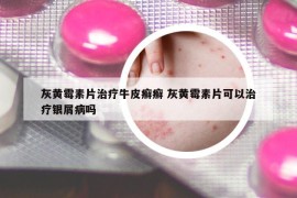 灰黃霉素片治療牛皮癬癬 灰黃霉素片可以治療銀屑病嗎