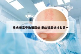 重慶哪家專治銀屑病 重慶銀屑病排名第一