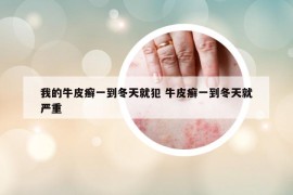 我的牛皮癬一到冬天就犯 牛皮癬一到冬天就嚴(yán)重