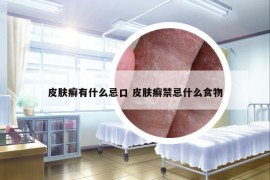 皮膚癬有什么忌口 皮膚癬禁忌什么食物