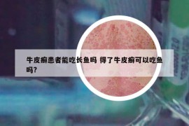 牛皮癬患者能吃長魚嗎 得了牛皮癬可以吃魚嗎?