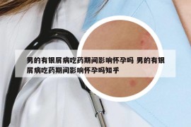 男的有銀屑病吃藥期間影響懷孕嗎 男的有銀屑病吃藥期間影響懷孕嗎知乎
