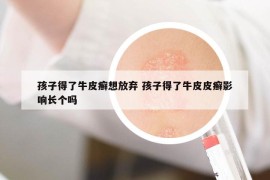 孩子得了牛皮癬想放棄 孩子得了牛皮皮癬影響長個嗎