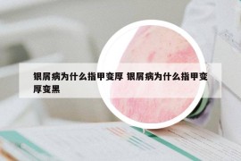 銀屑病為什么指甲變厚 銀屑病為什么指甲變厚變黑
