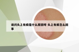 請問頭上有癬是什么原因呀 頭上有癬怎么回事
