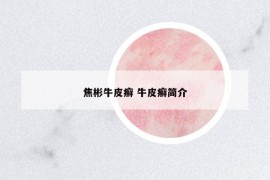 焦彬牛皮癬 牛皮癬簡介