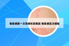 銀屑病第一次發(fā)病年齡原因 銀屑病首次病程