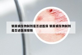 銀屑病生物制劑是否進(jìn)醫(yī)保 銀屑病生物制劑是否進(jìn)醫(yī)保報銷