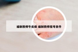 編制教師牛皮癬 編制教師報考條件