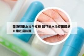 醋泡花椒水治牛皮癬 醋花椒水治療銀屑病 白醋還是陳醋