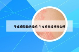 牛皮癬能勤洗澡嗎 牛皮癬能經(jīng)常洗頭嗎