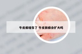 牛皮癬增生了 牛皮膚癬會(huì)擴(kuò)大嗎