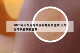 2023年山東治療牛皮癬最好的醫(yī)院 山東治療銀屑病的醫(yī)院