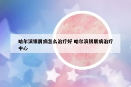 哈爾濱銀屑病怎么治療好 哈爾濱銀屑病治療中心