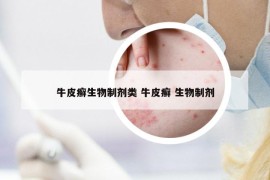 牛皮癬生物制劑類 牛皮癬 生物制劑