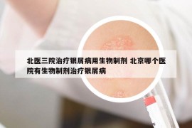 北醫(yī)三院治療銀屑病用生物制劑 北京哪個(gè)醫(yī)院有生物制劑治療銀屑病