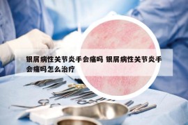銀屑病性關(guān)節(jié)炎手會(huì)痛嗎 銀屑病性關(guān)節(jié)炎手會(huì)痛嗎怎么治療