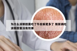 為什么消銀膠囊吃了牛皮癬更多了 銀屑病吃消銀膠囊沒有效果