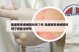 美國銀屑病病因找到了嗎 美國銀屑病病因找到了嗎能治好嗎