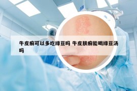 牛皮癬可以多吃綠豆嗎 牛皮膚癬能喝綠豆湯嗎